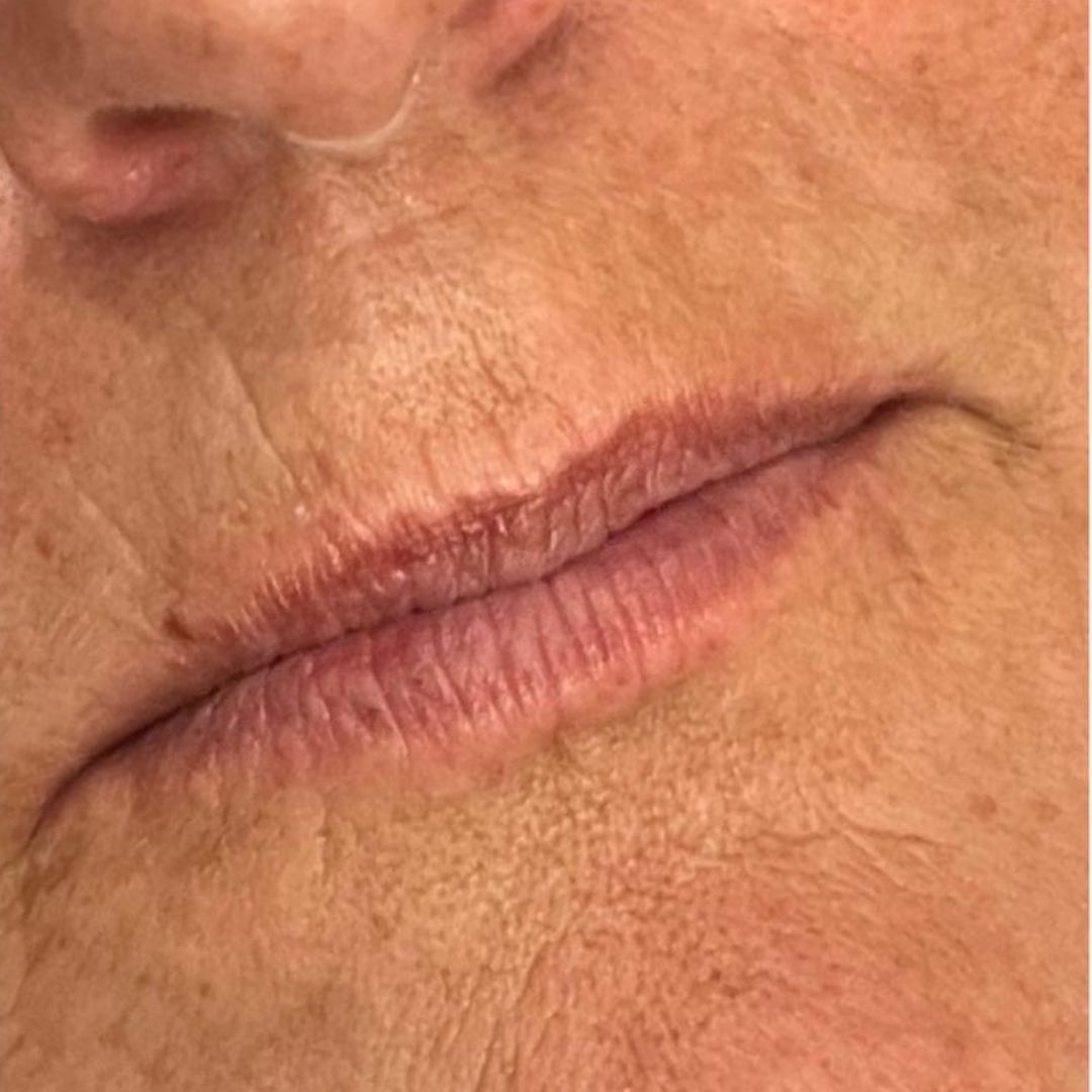 Foto van de lippen vóór het toevoegen van lipvolume, zonder definitie in de randen.