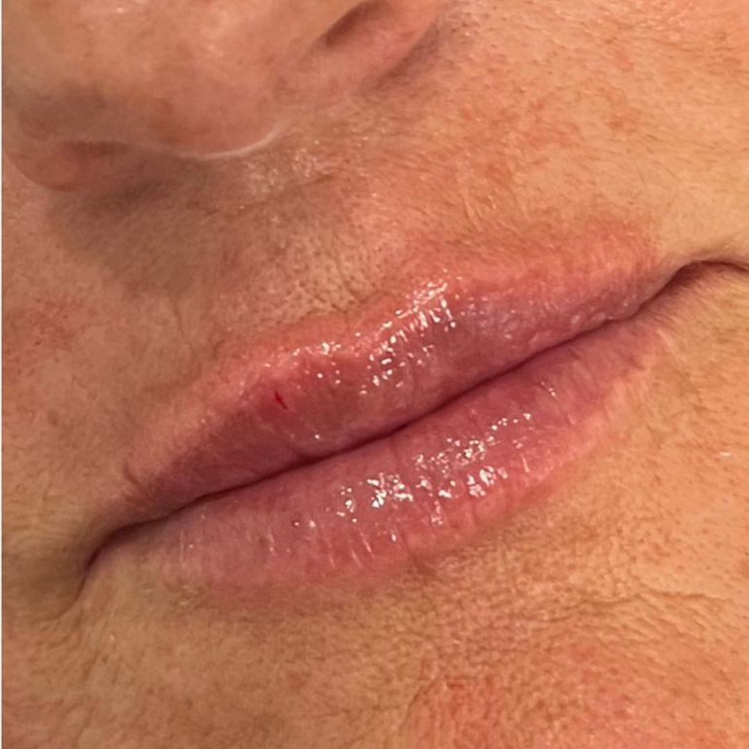 Foto na de behandeling, met voller ogende lippen en strakkere lipcontour.