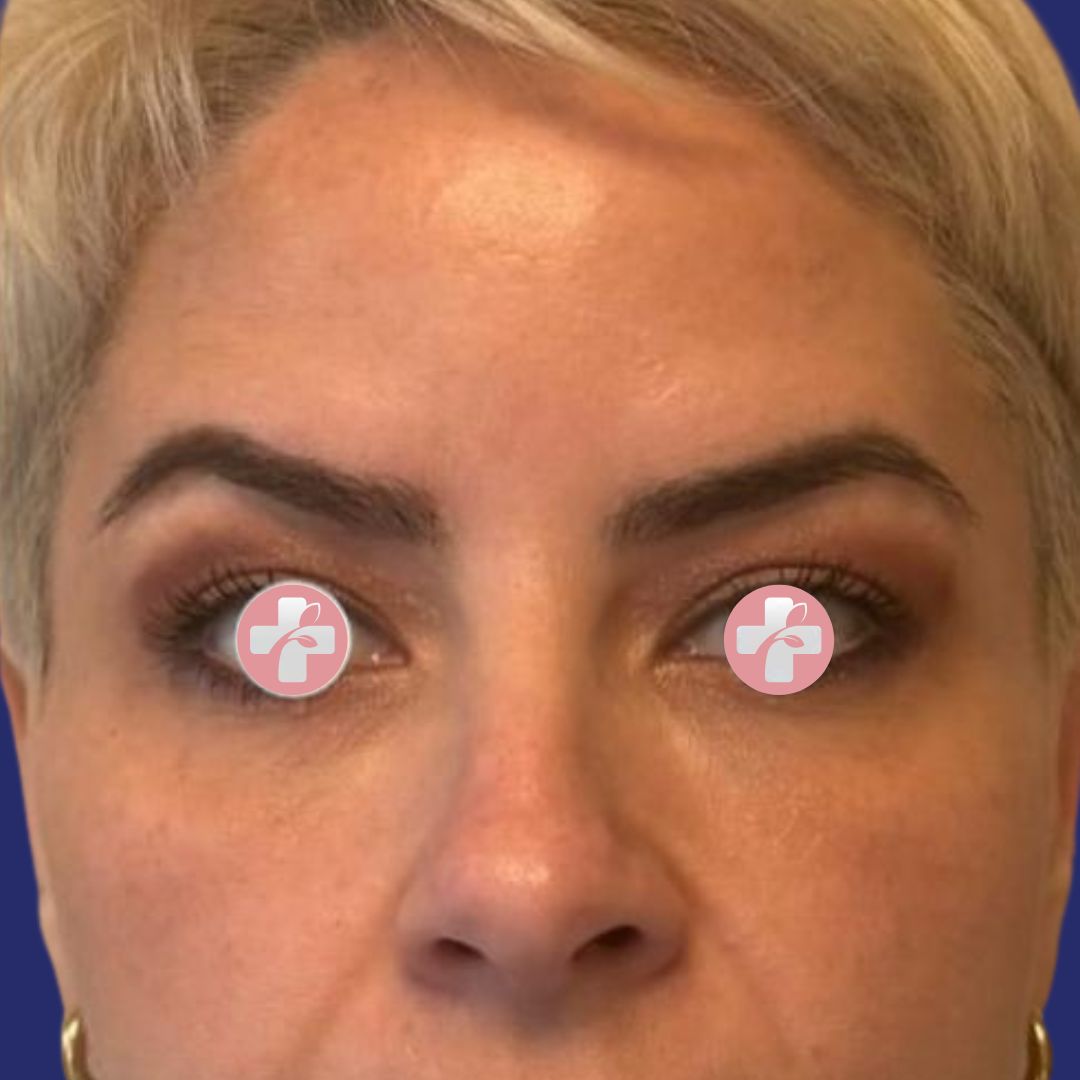 After image following botulinum toxin treatment with smoother forehead appearance.