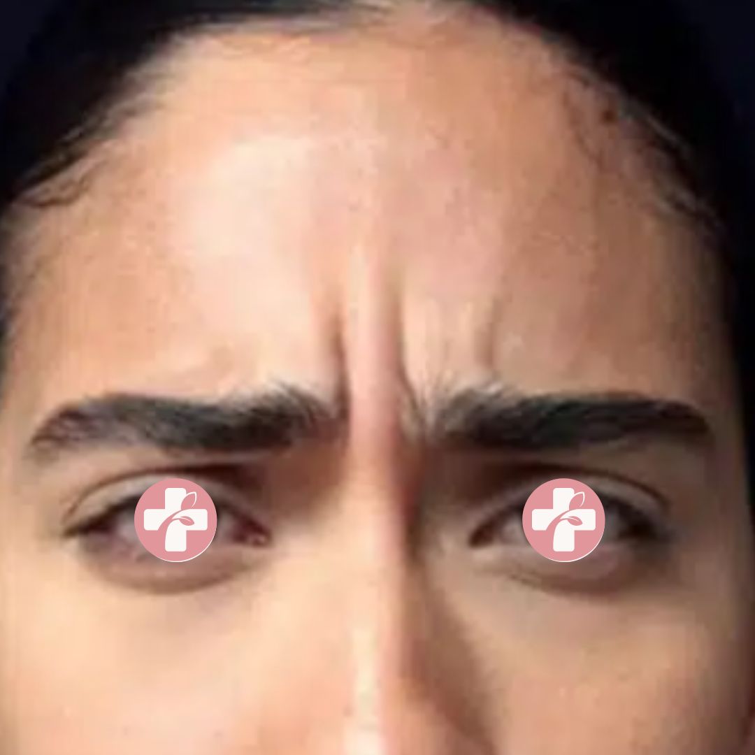 Patient before neuromodulator treatment showing dynamic forehead lines while frowning.