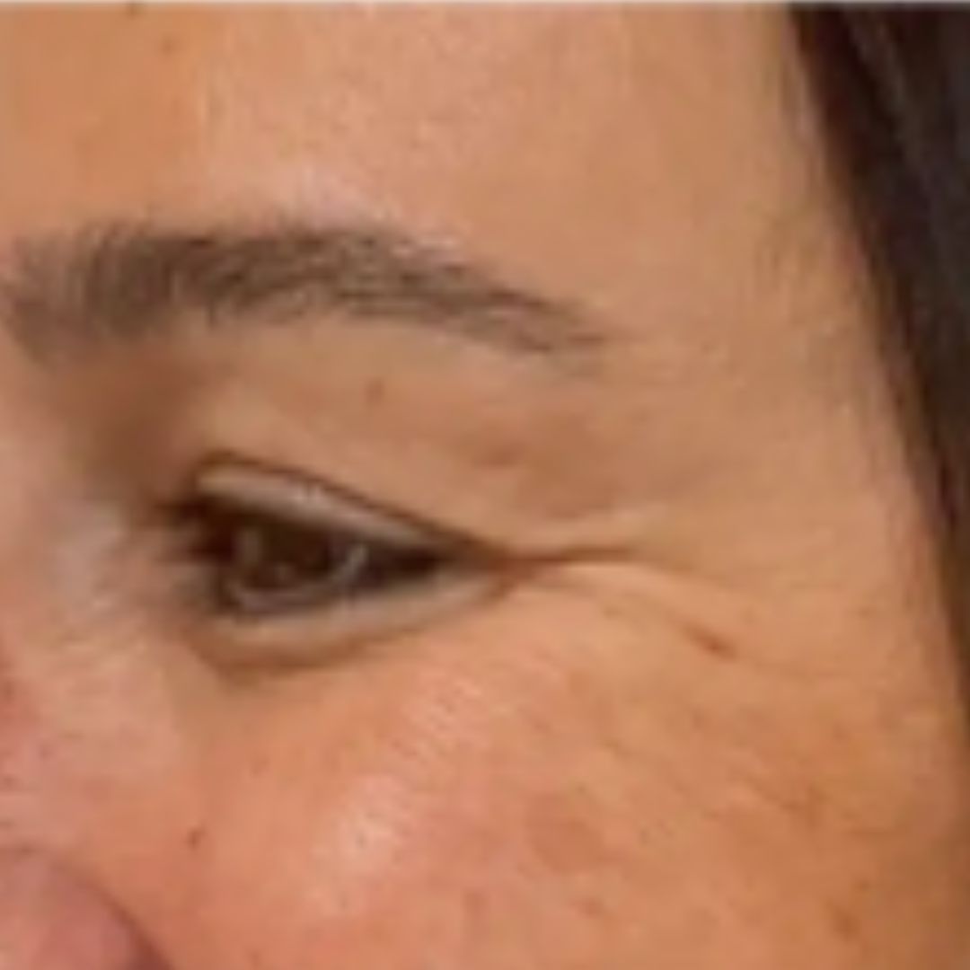 After image showing softened crow’s feet and a more refreshed eye area.