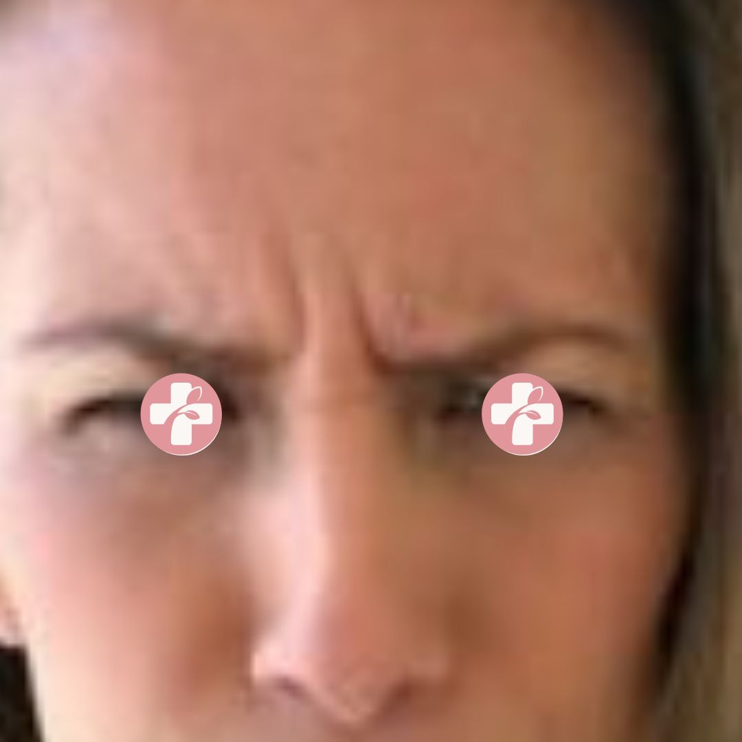 Before image with visible forehead expression lines.