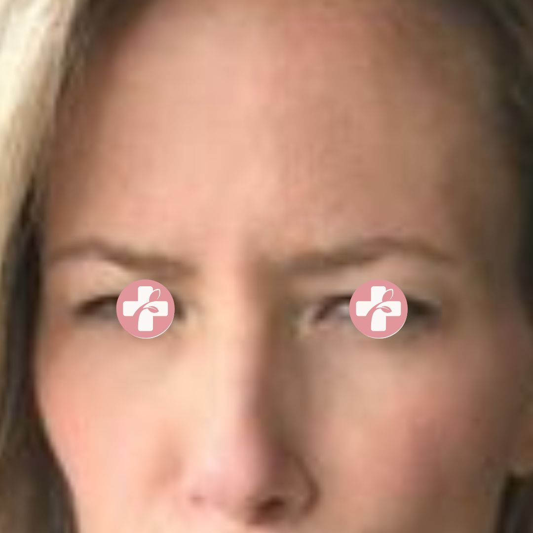 After image showing naturally softened forehead wrinkles following treatment.