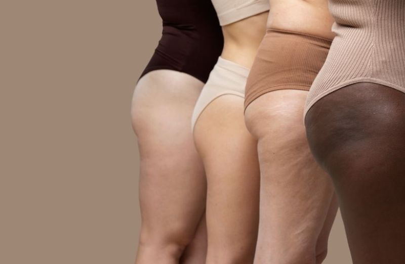 Lipoedema treatment | Before and After